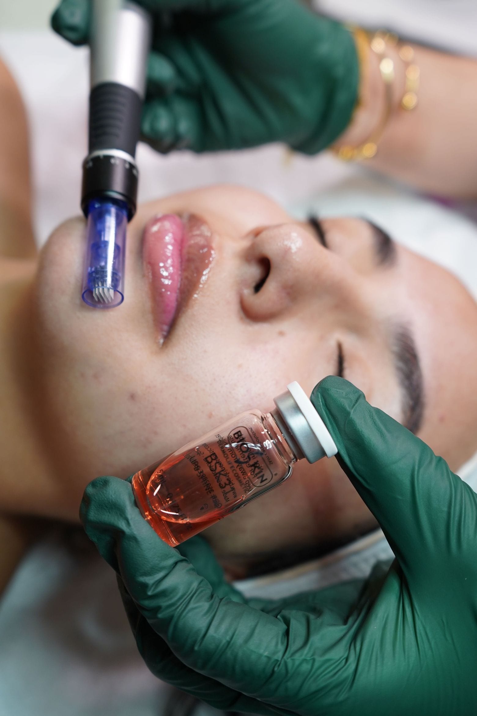 Microneedling with a professional ampoule during a facial